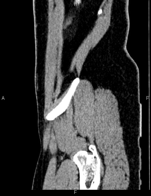 Bilateral ovarian teratoma (Radiopaedia 83131-97503 D 100).jpg