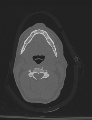 Bilateral perched facet joint (Radiopaedia 63149-71669 Axial bone window 19).jpg