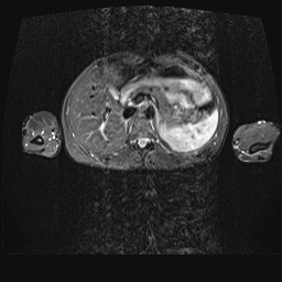 File:Bilateral spinoglenoid notch ganglion cysts (Radiopaedia 29577-30082 E 35).jpg