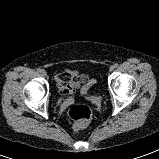 Bilateral staghorn calculi (Radiopaedia 59475-66842 Axial non-contrast 79).jpg