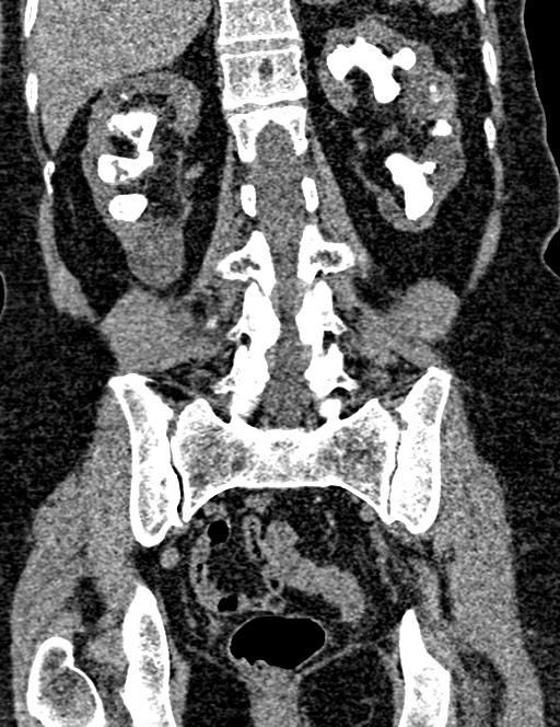Bilateral staghorn calculi (Radiopaedia 59475-66842 Coronal non-contrast 73).jpg
