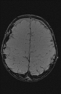 File:Bilateral subdural hemorrhage and parietal skull fracture (Radiopaedia 26058-26190 Axial SWI 61).png