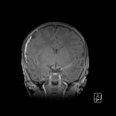 File:Bilateral subdural hemorrhage and parietal skull fracture (Radiopaedia 26058-26190 Coronal T1 22).png