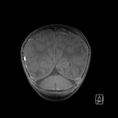Bilateral subdural hemorrhage and parietal skull fracture (Radiopaedia 26058-26190 Coronal T1 43).png