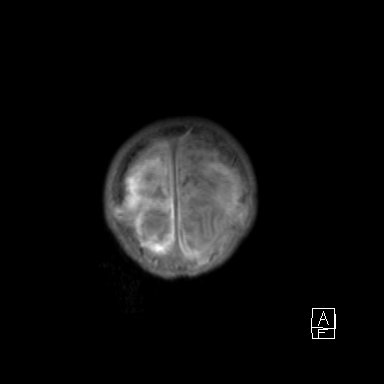 Bilateral subdural hemorrhage and parietal skull fracture (Radiopaedia 26058-26190 Coronal T1 56).png