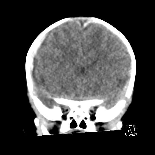 File:Bilateral subdural hemorrhage and parietal skull fracture (Radiopaedia 26058-26192 Coronal non-contrast 9).png