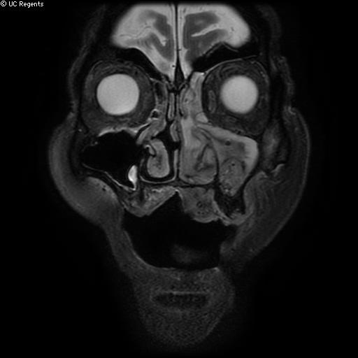 File:Bisphosphonate-related osteonecrosis of the maxilla (Radiopaedia 51367-57101 Coronal T2 fat sat 24).jpg