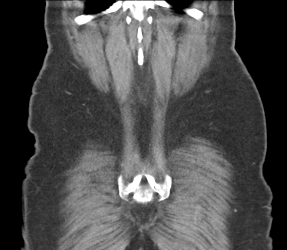 File:Bladder papillary urothelial carcinoma (Radiopaedia 48119-52951 C 58).png