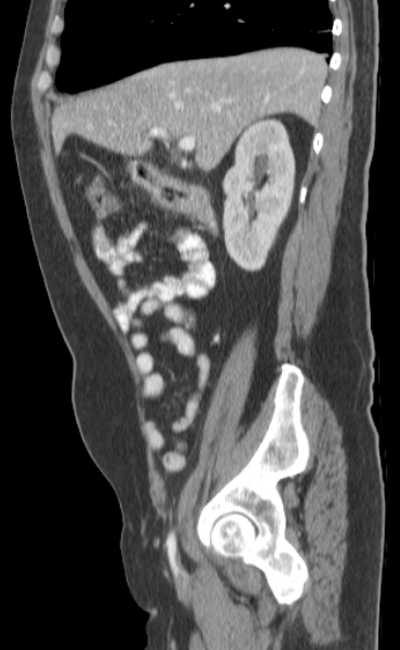 Bleeding duodenal ulcer and adenomyomatosis of gallbladder (Radiopaedia 61834-69861 C 31).jpg