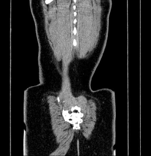 Blind-ending branch of a bifid ureter (Radiopaedia 61159-69048 C 68).jpg