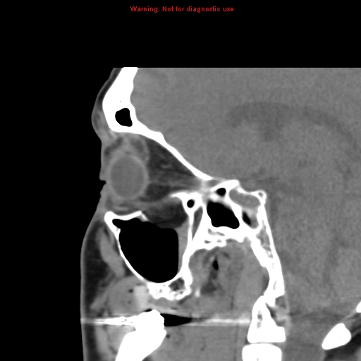 File:Blowout fracture with inferior rectus entrapment (Radiopaedia 12418-12673 C 12).jpg