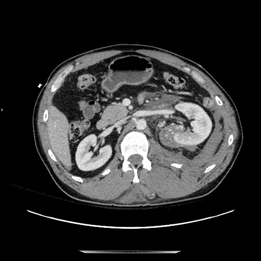 Blunt abdominal trauma with solid organ and musculoskelatal injury with active extravasation (Radiopaedia 68364-77895 A 55).jpg