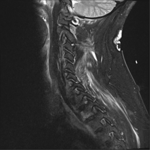 File:Blunt cerebrovascular injury (Radiopaedia 53682-59744 Sagittal T2 fat sat 3).png