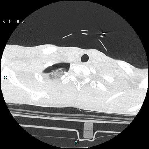 Blunt chest trauma (Swiss cheese sign) (Radiopaedia 38519-40618 Axial lung window 1).jpg