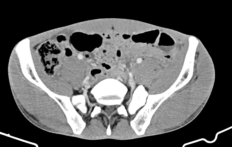 Blunt injury to the small bowel (Radiopaedia 74953-85987 A 142).jpg