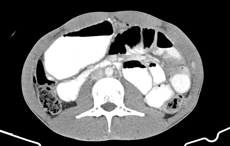 Blunt injury to the small bowel (Radiopaedia 74953-85987 A 81).jpg