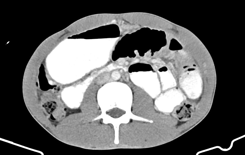Blunt injury to the small bowel (Radiopaedia 74953-85987 A 83).jpg