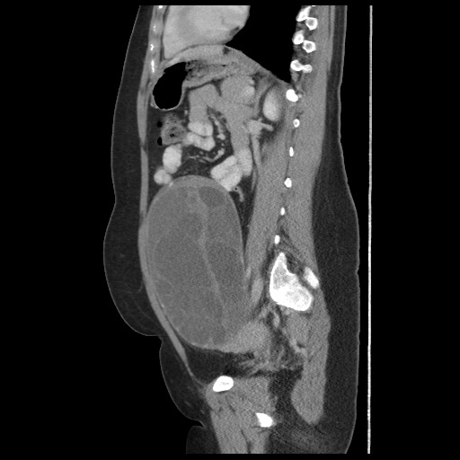 File:Borderline mucinous tumor (ovary) (Radiopaedia 78228-90808 B 42).jpg