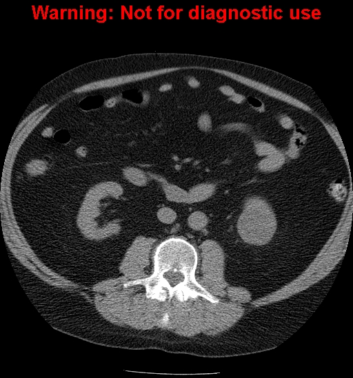 File:Bosniak renal cyst - type IV (Radiopaedia 23402-23466 Axial non-contrast 15).jpg