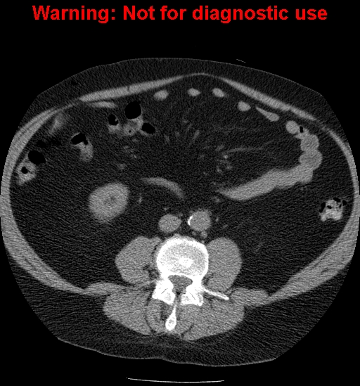 File:Bosniak renal cyst - type IV (Radiopaedia 23402-23466 Axial non-contrast 19).jpg
