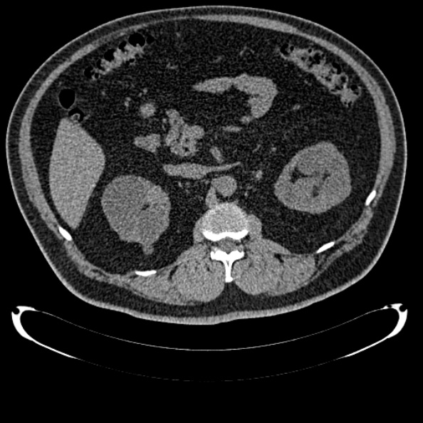 Bosniak renal cyst - type IV (Radiopaedia 24244-24518 Axial non-contrast 137).jpg