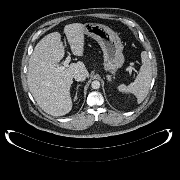 Bosniak renal cyst - type IV (Radiopaedia 24244-24518 C 69).jpg