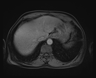 Bouveret syndrome (Radiopaedia 61017-68856 Axial T1 C+ fat sat 14).jpg