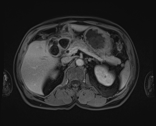 Bouveret syndrome (Radiopaedia 61017-68856 Axial T1 C+ fat sat 32).jpg