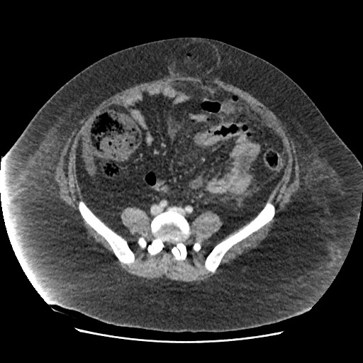 Bowel and splenic infarcts in acute lymphocytic leukemia (Radiopaedia 61055-68915 A 90).jpg