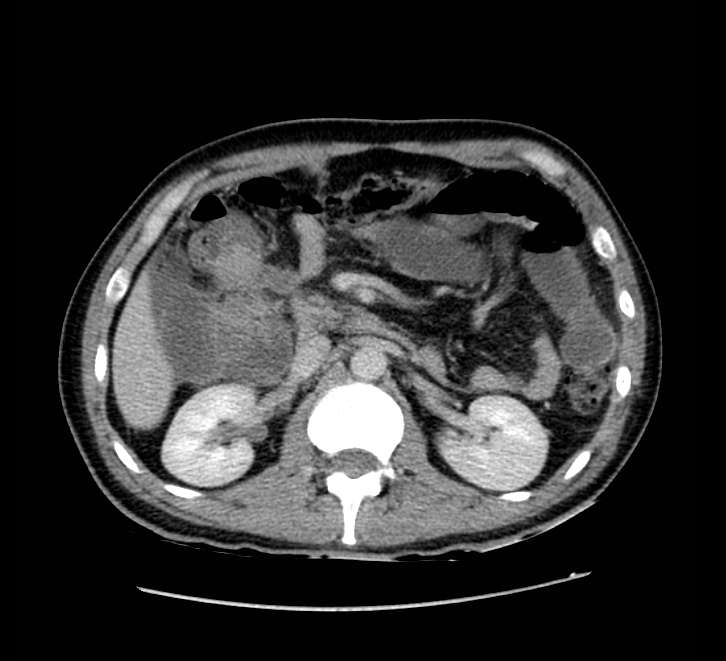 Bowel obstruction from colon carcinoma (Radiopaedia 22995-23028 A 31).jpg