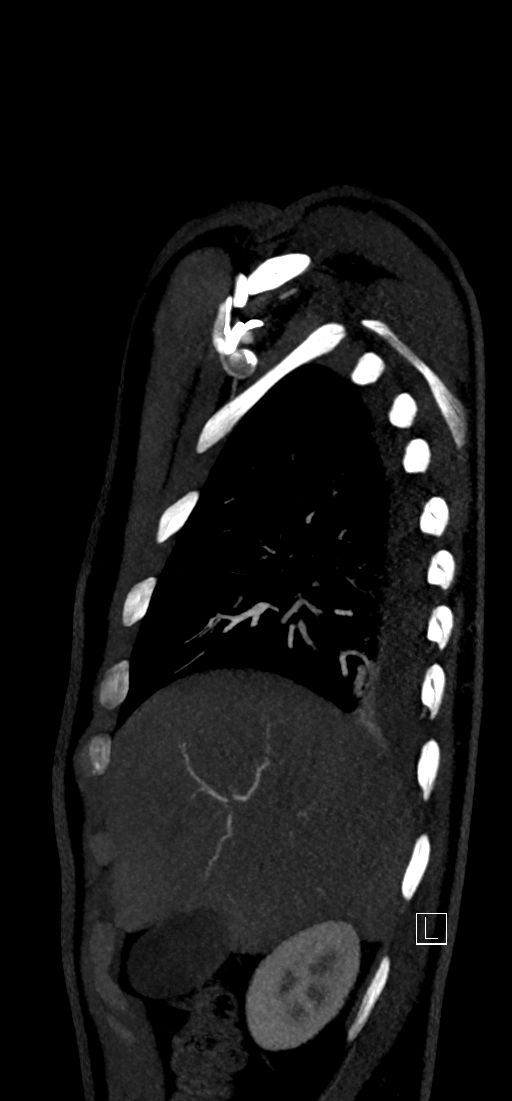 Brachiocephalic trunk pseudoaneurysm (Radiopaedia 70978-81191 C 20).jpg