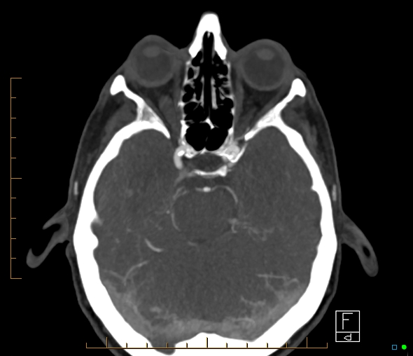 Brachiocephalic trunk stenosis (Radiopaedia 87242-103519 A 46).jpg