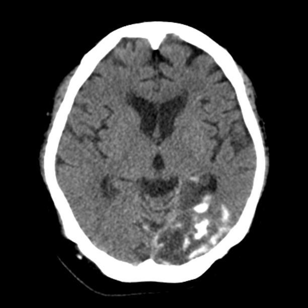 Brain cortical laminar necrosis (Radiopaedia 25822-25971 Axial non-contrast 21).jpg