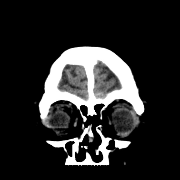 Brain cortical laminar necrosis (Radiopaedia 25822-25971 C 7).jpg