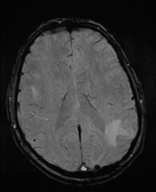 Brain metastases - lung cancer primary (Radiopaedia 75060-86115 Axial SWI 37).jpg