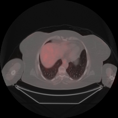 Brain metastasis (Radiopaedia 89847-106962 Axial lung window 47).jpg