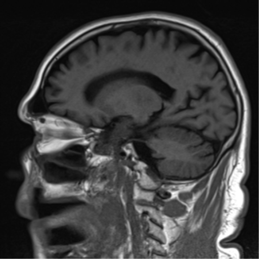 File:Brain metastasis (large cystic mass) (Radiopaedia 47497-52107 Sagittal T1 18).png