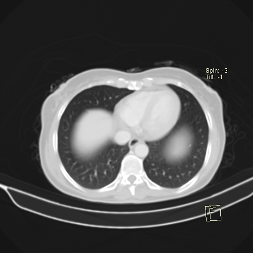 File:Brain metastasis as initial presentation of non-small cell lung cancer (Radiopaedia 65122-74127 Axial lung window 35).jpg