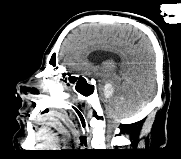 Brainstem hemorrhage (Radiopaedia 81294-94976 C 27).jpg