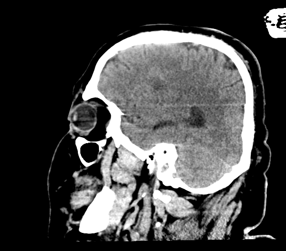 Brainstem hemorrhage (Radiopaedia 81294-94976 C 42).jpg