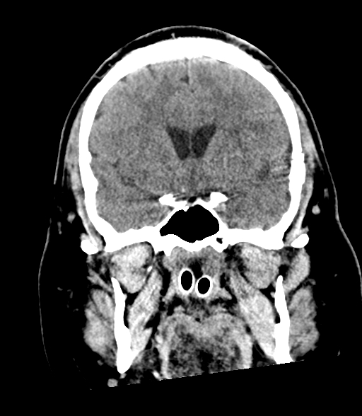 Brainstem hemorrhage (Radiopaedia 81294-94976 Coronal non-contrast 27).jpg
