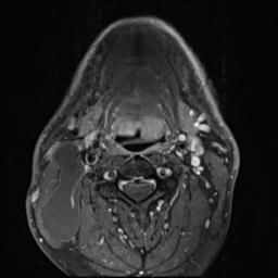File:Branchial cleft cyst (Radiopaedia 31167-31876 Axial T1 C+ fat sat 12).jpg