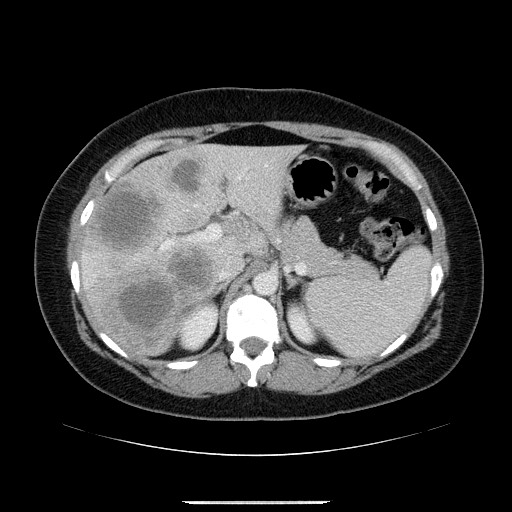 File:Breast cancer pseudocirrhosis after chemotherapy (Radiopaedia 65407-74456 A 25).jpg