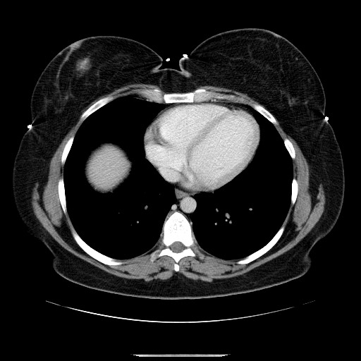 File:Breast cancer pseudocirrhosis after chemotherapy (Radiopaedia 65407-74456 Axial 45).jpg