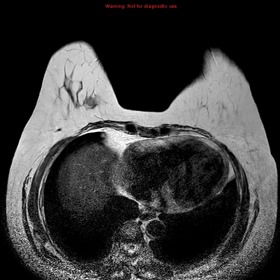 File:Breast carcinoma (multicentric multifocal in mammary Paget disease) (Radiopaedia 50966-56512 Axial T2 1).jpg