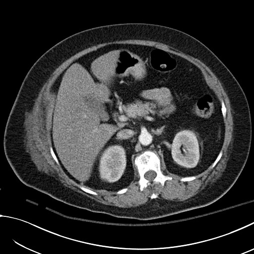 File:Breast carcinoma with pathological hip fracture (Radiopaedia 60314-67974 A 55).jpg