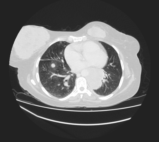 Breast metastases from facial malignant melanoma (Radiopaedia 60316-67975 Axial lung window 69).jpg