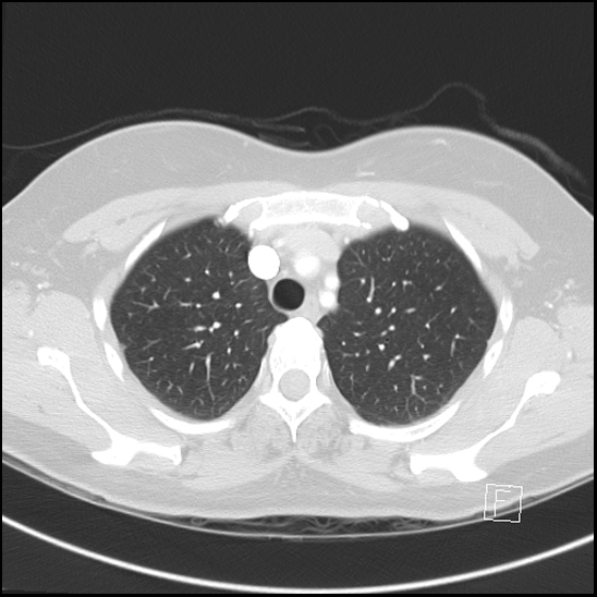 File:Breast metastases from renal cell cancer (Radiopaedia 79220-92225 Axial lung window 18).jpg