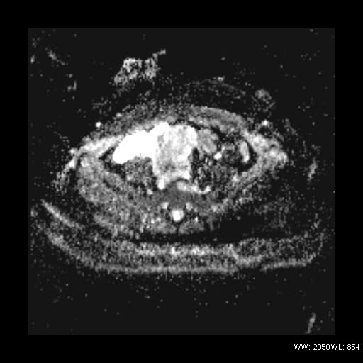 File:Broad ligament fibroid (Radiopaedia 49135-54241 Axial ADC 11).jpg