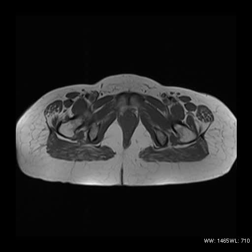 File:Broad ligament fibroid (Radiopaedia 49135-54241 Axial T1 14).jpg